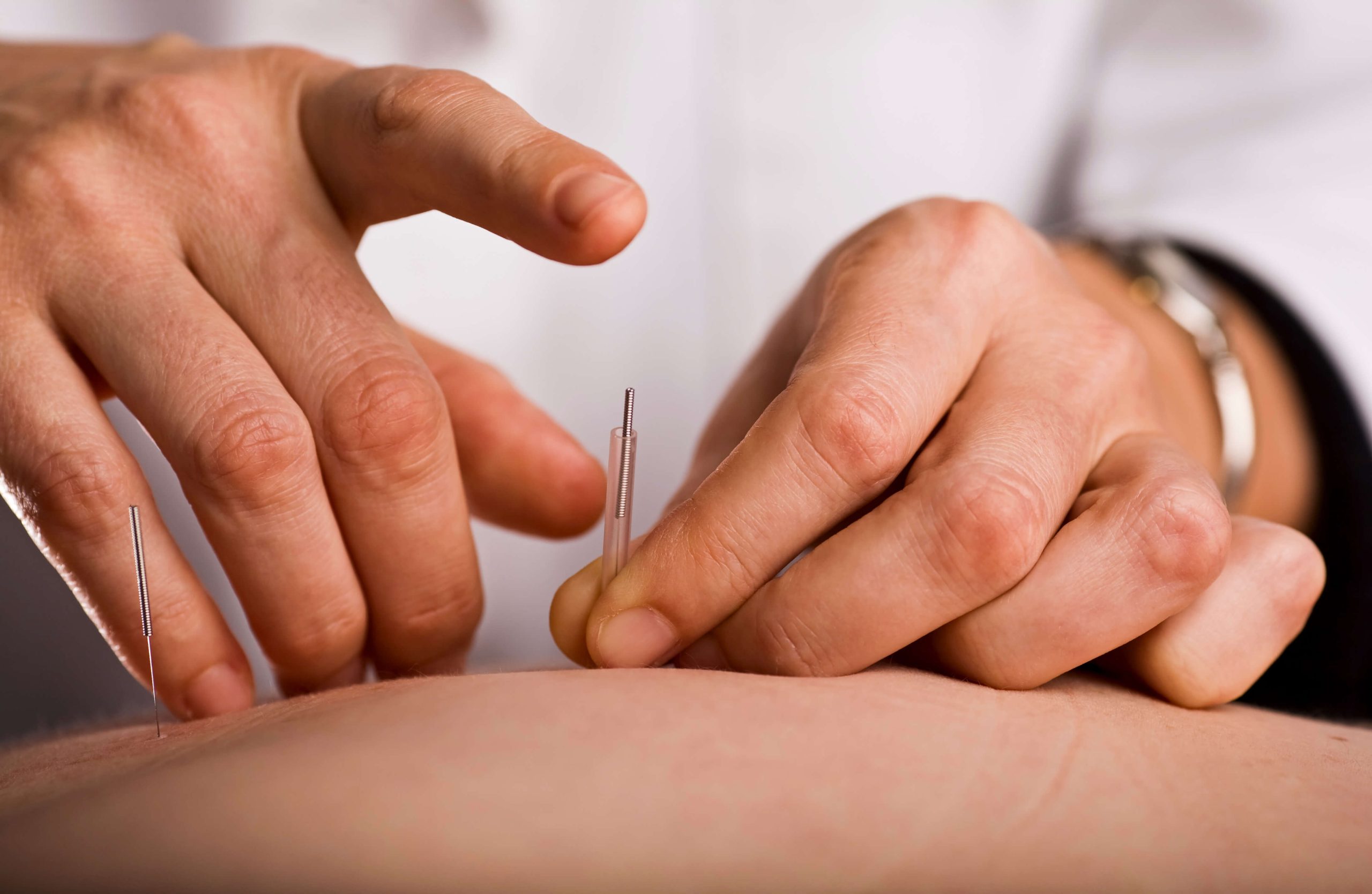 acupuncture needles are pain-free Scott Gralla Acupuncture L.Ac Greenlawn NY